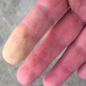 Finger at the left in the photo is an example of a Raynaud's-afflicted digit.